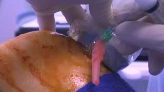 WATCH a Knee Joint Injection  LIVE [upl. by Oiralednac]