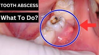 How To Treat A Tooth Abscess [upl. by Ayota]