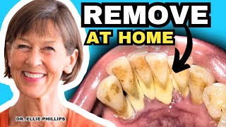 Tartar Removal At Home and How To Prevent Tartar [upl. by Edieh]