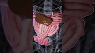 Understanding Small Bowel Perforation anatomy biology 3danimation [upl. by Adnalohs]