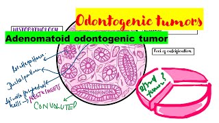 Adenomatoid odontogenic tumor HISTOPATHOLOGYradiographic featuresclinical featuresTreatment [upl. by Aihcela]