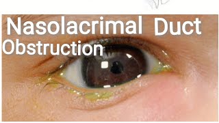 Lacrimal System  Anatomy  Congenital nasolacrimal duct obstruction Part 1 [upl. by Pickard378]