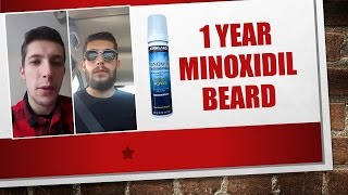 Minoxidil Beard  1 Year  Week 52  Minoxidil 5 for Beard Growth  Facialfuzzfridays [upl. by Pinebrook]