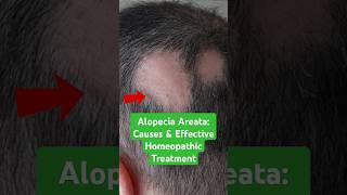 Alopecia Areata Causes amp Effective Homeopathic Treatment shorts [upl. by Lissa]