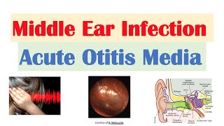 Middle Ear Infection Acute Otitis Media  Causes Symptoms Diagnosis Treatment [upl. by Placido]