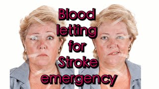 Bleeding to save Stroke and Heart attack emergency [upl. by Boyden]