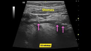 Submandibular duct stones [upl. by Tiler]