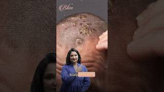 Scalp Psoriasis Treatment  Skin Doctor in Ludhiana  Dr Shikha Aggarwal [upl. by Ojytteb]