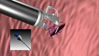 OverStitch™ Animation  Suturing Sequence [upl. by Essie]