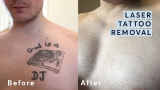 Laser Tattoo Removal  Before and After through all the stages [upl. by Guyer]