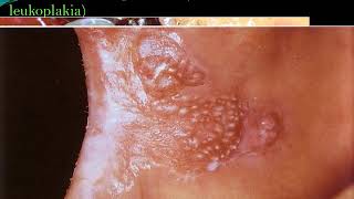 PRECANCEROUS LESIONS AND CONDITIONS [upl. by Ohnuj]