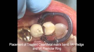 Clinical Case Study of Class II Restoration Tooth 21 ADA 34 FDI By Dr John C Comisi [upl. by Rice]