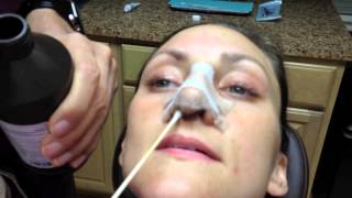 Rhinoplasty Recovery days 1 through 7 Nose Cleaning Instructions  Dr Naderi [upl. by Steele]