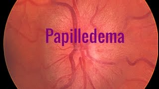 Papilledema A Swollen optic disc [upl. by Landahl406]