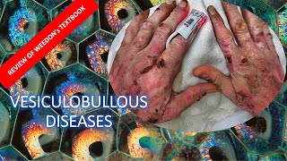 Dermatopathology Lesson 4 Vesiculobullous Diseases Tissue Reaction Patterns [upl. by Schott506]