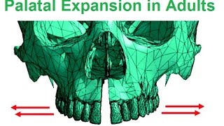 Is Palatal Expansion Possible In Adults By Dr Mike Mew [upl. by Nalyt]