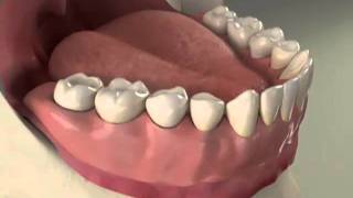 Lower Implant supported Complete Denture [upl. by Crescentia]