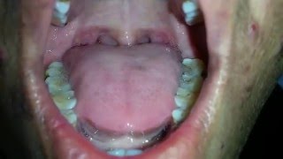 Tongue Fasciculation in MND [upl. by Pudens976]