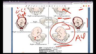 mechanism of labour 2 [upl. by Mailliwnhoj379]