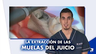 Extracción Muela del Juicio en 4K  Cuidados post operatorios [upl. by Mahgirb]