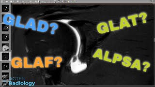 MRI of Glenoid Labral Flap Tear  A Pathognomonic Lesion Rare [upl. by Raynah147]