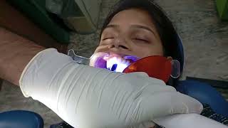 Process of getting fixed retainers after braces by Dr Abhishek Kumar at Magadh Oro Dental patna [upl. by Llerrut]