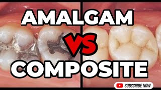 Amalgam vs Composite fillings  ALL REVEALED [upl. by Adnalue757]