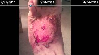 2nd Degree burns on foot  healing time lapse  2 months [upl. by Woodsum]