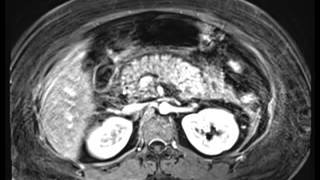 Acute Pancreatitis [upl. by Dalis]