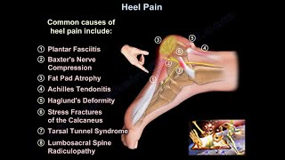 Heel Pain causes and treatment plantar fasciitis diagnosis and treatment [upl. by Submuloc]