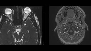 case 22 diplopia and squint [upl. by Hussey]