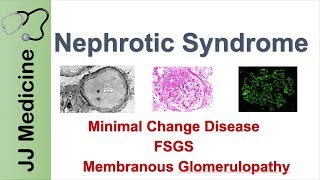 Nephrotic Syndrome  Clinical Presentation Causes and Treatment [upl. by Ettegdirb928]