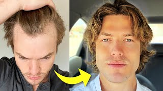 My Turkey Hair Transplant Results After 1 Year  Before amp After [upl. by Francine]