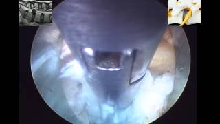 Percutaneous Endoscopic Transforaminal Lumbar Discectomy PETLD by Dr Hyeun Sung Kim02 [upl. by Valli]