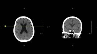 Unremarkable NonContrast Head CT Coronal Scan  Example 1 [upl. by Martynne]