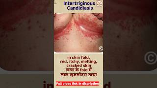 candidiasis  fungal skin infection  oral thrush shorts reels [upl. by Gui]