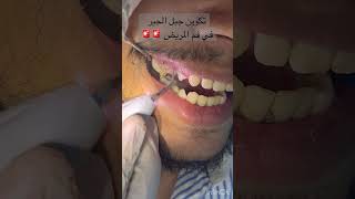 عملية تنضيف الاسنان ضروري جدا جدا  اغرب حالة😳😳🚨 dentalcare scaling تنضيفالاسنان [upl. by Fridlund]