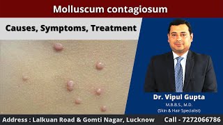 Molluscum contagiosum  Causes Symptoms Treatment [upl. by Galateah670]