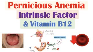 Pernicious Anemia Rare Cause of Vitamin B12 Deficiency  Causes Symptoms Diagnosis Treatment [upl. by Cusack175]