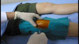 Knee aspiration technique Knee synovitis เจาะเข่า เข่าอักเสบ [upl. by Herwick]