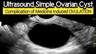 Ultrasound Simple Ovarian CYST  Complication of Medication induced Ovulation [upl. by Ruthy]