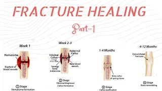 FRACTURE HEALING  PART1  STAGES amp FACTORS AFFECTING HEALING  PRIMARY amp SECONDARY HEALING [upl. by Lennej834]