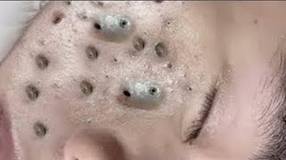 Big Cystic Acne Blackheads Extraction Blackheads amp Milia Whiteheads Removal Pimple Popping  5687 [upl. by Nirred]