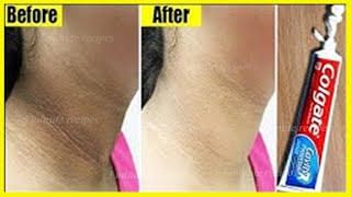 How to get rid of a dark neck is a natural and easy brown skin treatment around the neck [upl. by Monto]