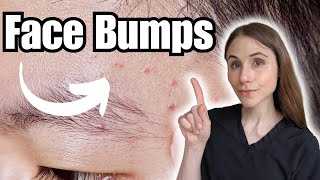 Face Bumps THAT ARE NOT Fungal Acne [upl. by Akeret]