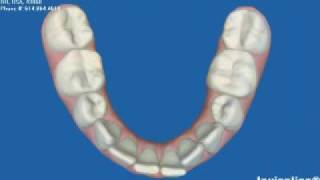 Invisalign Express OrthodonticsBefore amp AfterMick Family Dental [upl. by Ojela]