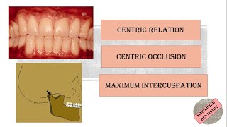 Centric Relation  Centric Occlusion  Maximum Intercuspation [upl. by Bliss]