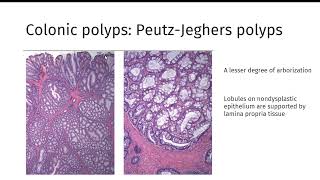 GI polyps GIPATH [upl. by Yerrok]