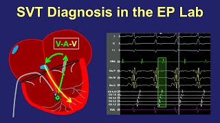 Diagnosis of SVT in the EP lab [upl. by Analeh]