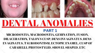 Developmental disturbances in teeth  Dental anomalies  Odontology notes  UGC NET Forensic science [upl. by Koal]